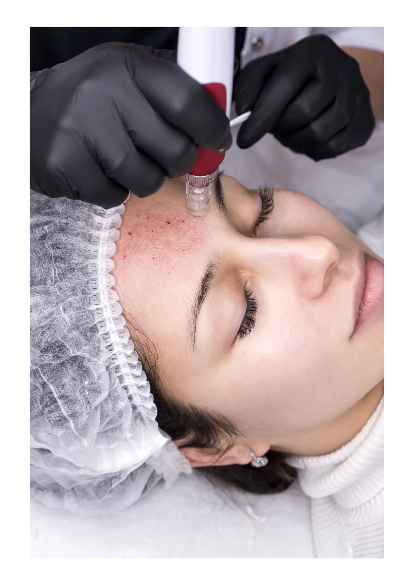 MEZOTERAPIA MIKROIGŁOWA